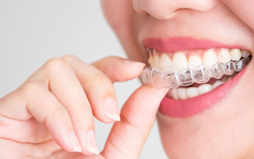 Tratamiento Invisalign