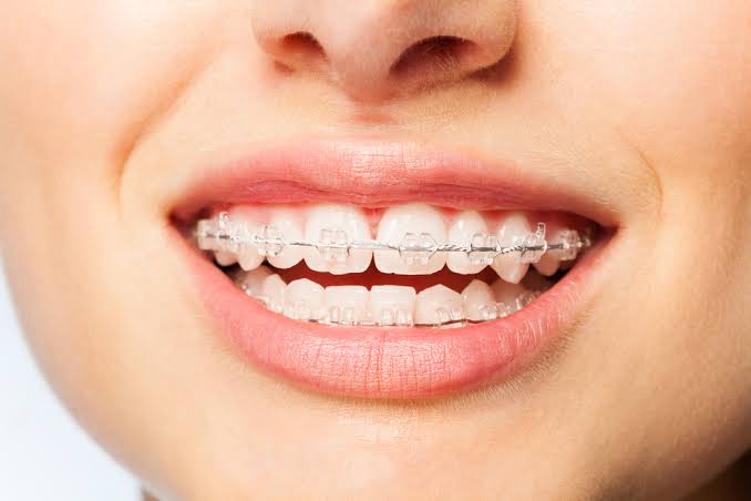 Braces Cerámicos Clear